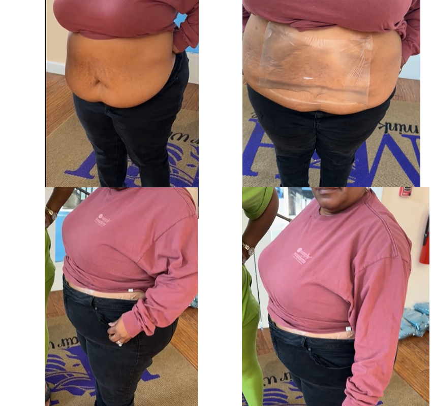 Before-and-after style tummy photos for Mink Tummy Tuck and Lift Patch.